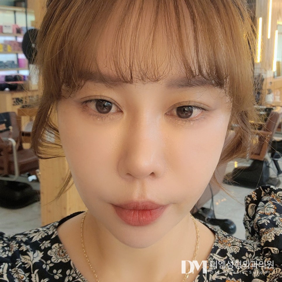 Improving Nasolabial Folds That Make You Look Older with a Partial Facelift image 14