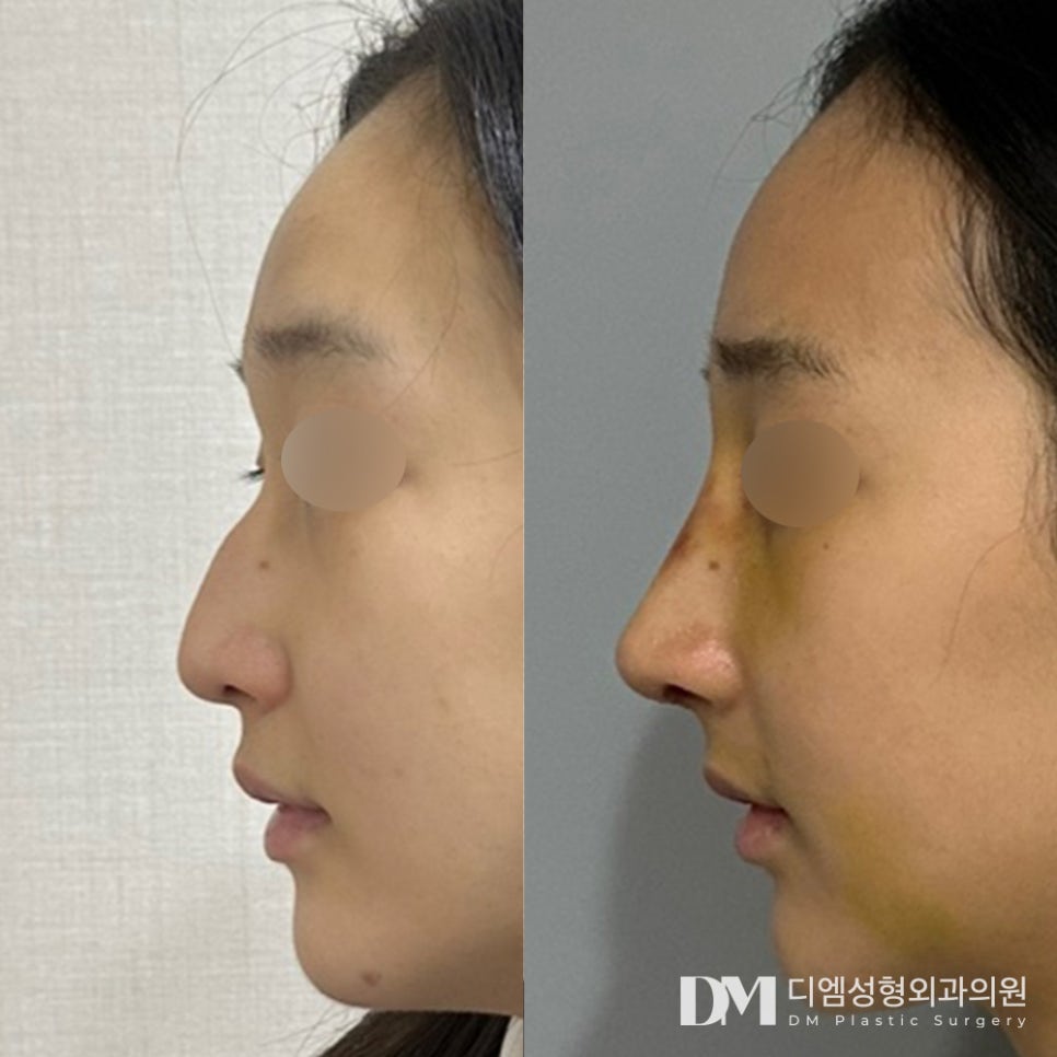 Perfecting Hump Nose Surgery with a Customized Surgical Plan image 7