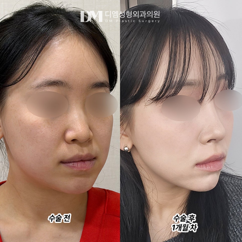 디엠 코성형 후기, &ldquo;제 얼굴형에 맞게 잘 해주셨어요!&rdquo; 관련 이미지 2