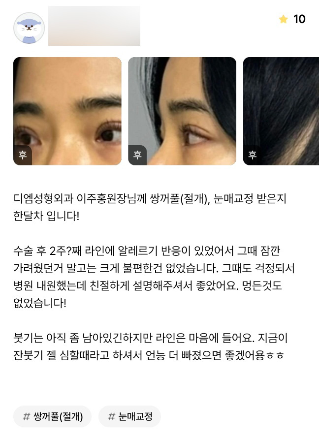 눈성형 후기."라인 너무 마음에 들어요!" 관련 이미지 1