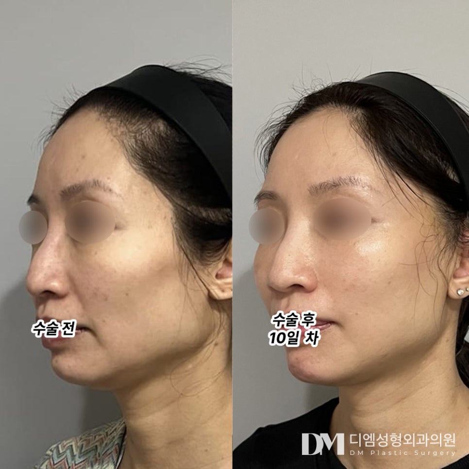 Mini Facelift: Reclaim Youth and Confidence! image 7