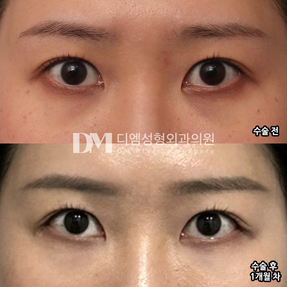 Ppangtwin Review. "My eyes definitely feel bigger, and people around me also said I look kinder, so I’m satisfied!" image 2