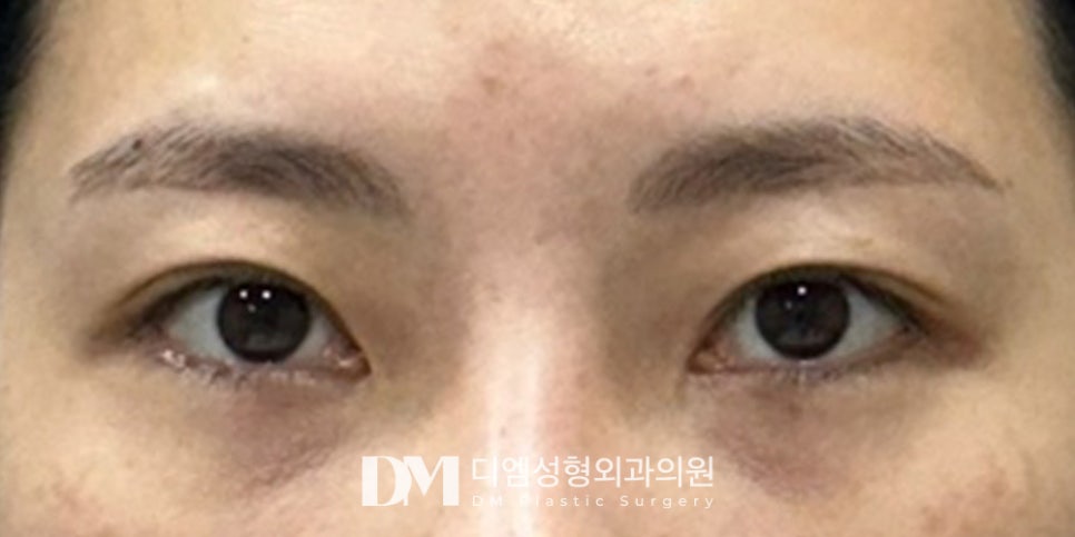 Revision Eyelid Surgery: Identifying the Cause of Failure Is Most Important! image 8