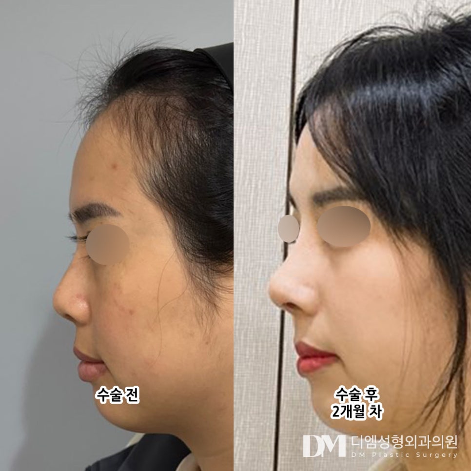 Short-Nose Rhinoplasty: Start with Accurate Cause Analysis and Diagnosis! image 8