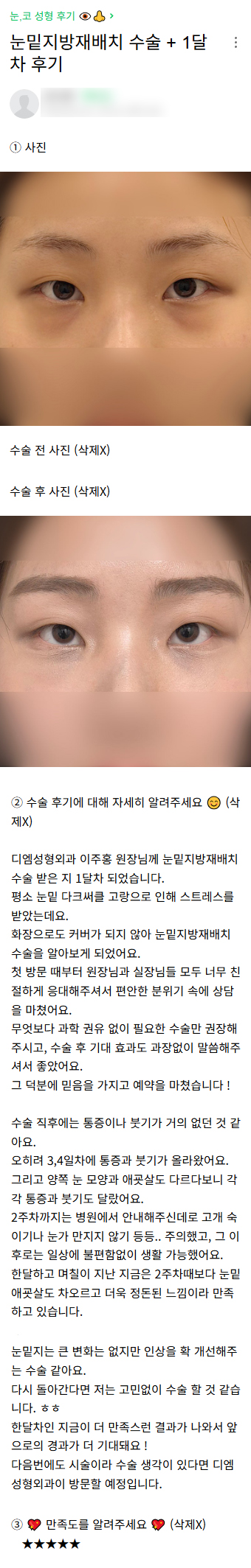 DM Under-Eye Fat Repositioning Surgery Review, “Even if I could go back, I think I would have the surgery without hesitation!” image 1
