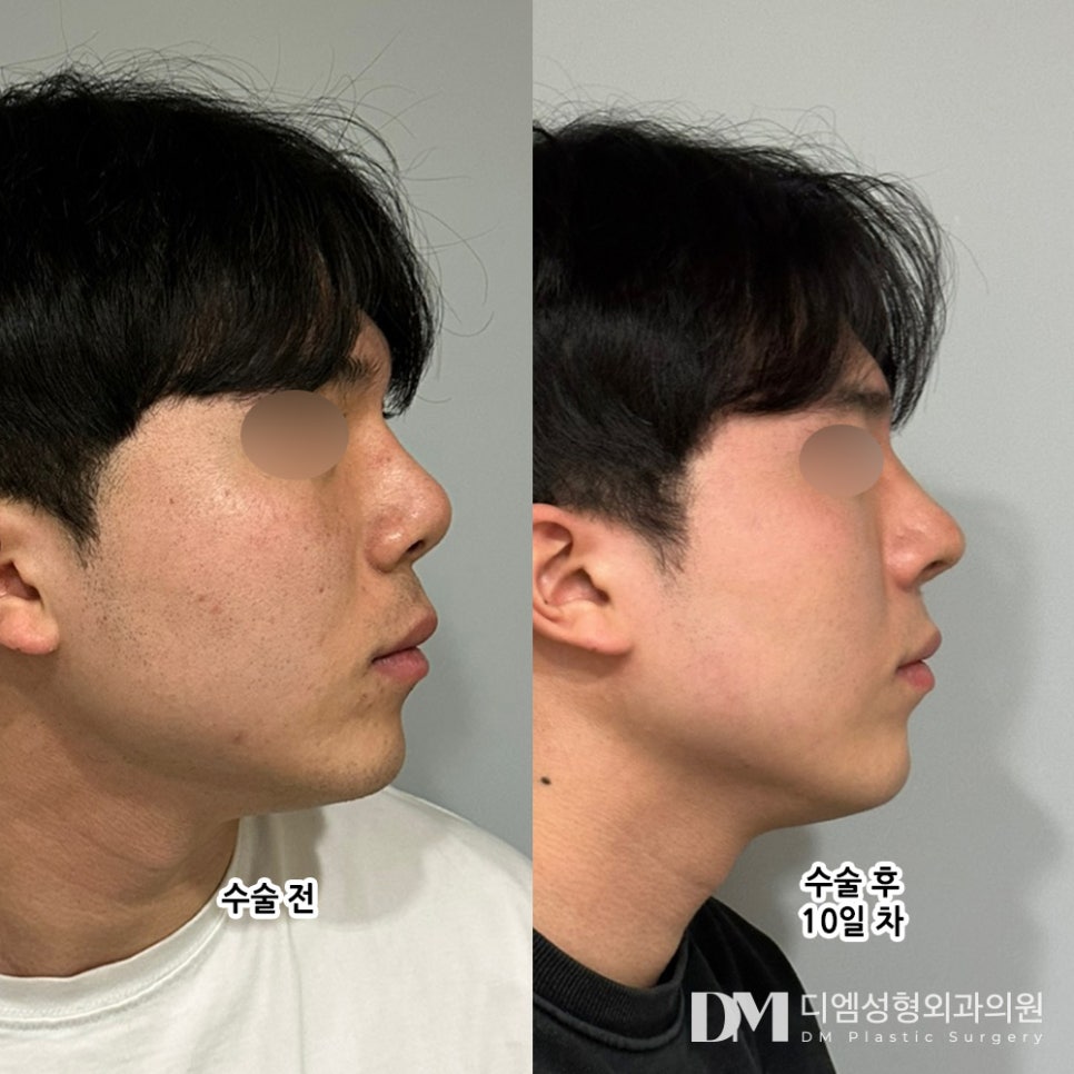 코재수술, 제대로 알자! 관련 이미지 10