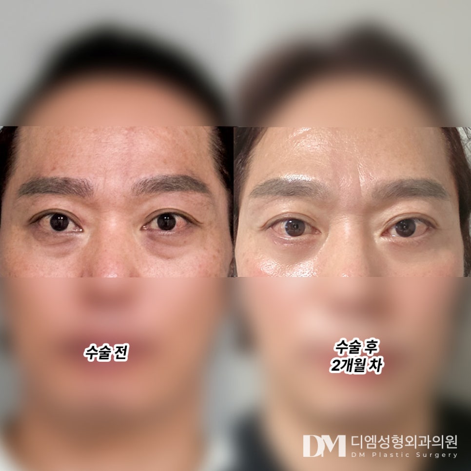 하안검, 불룩하고 어두운 눈 밑 지우개 관련 이미지 7