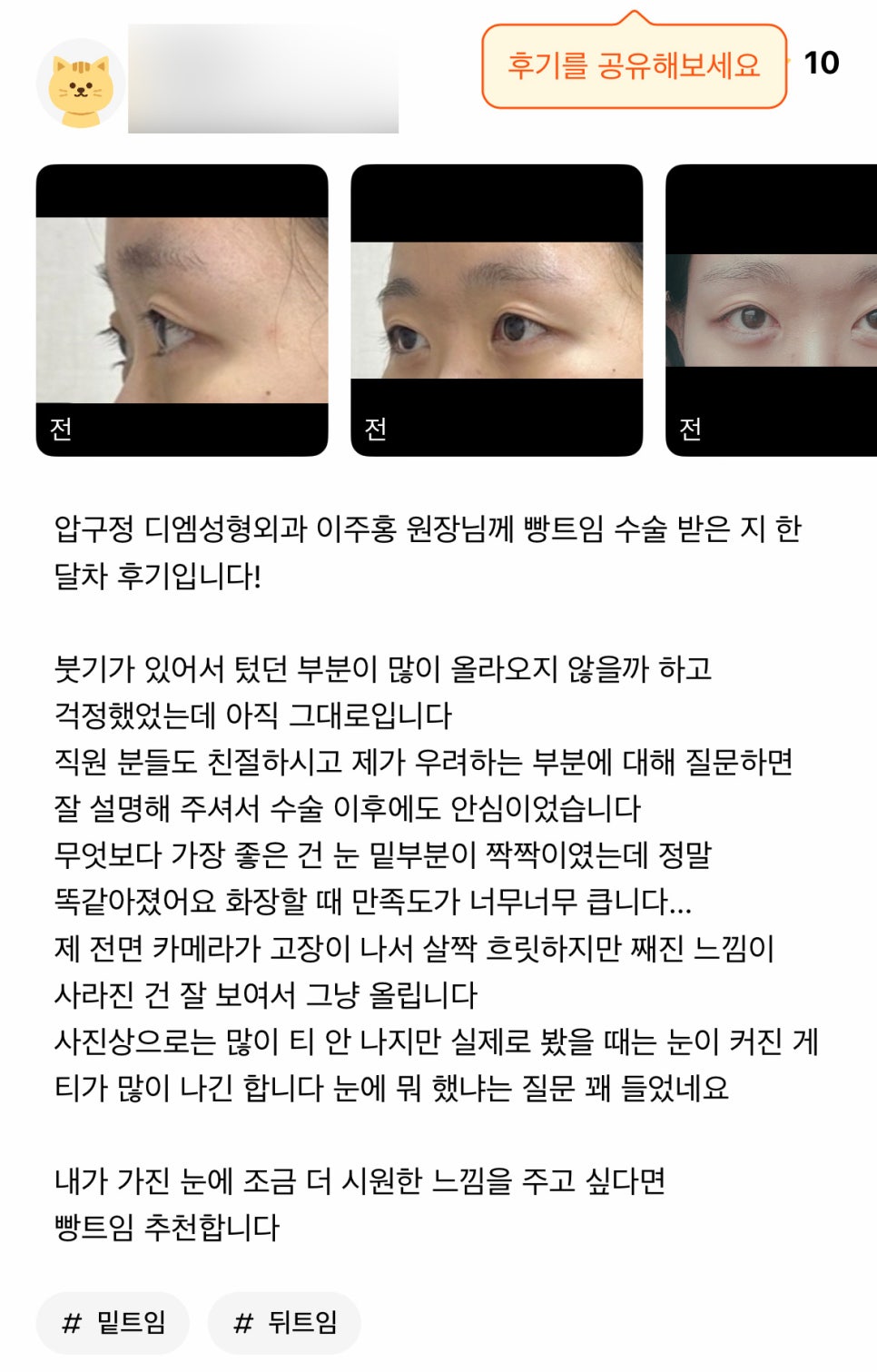 Eye-Opening Surgery Review. “Recommended if you want to give your eyes a more open, refreshed look!” image 1