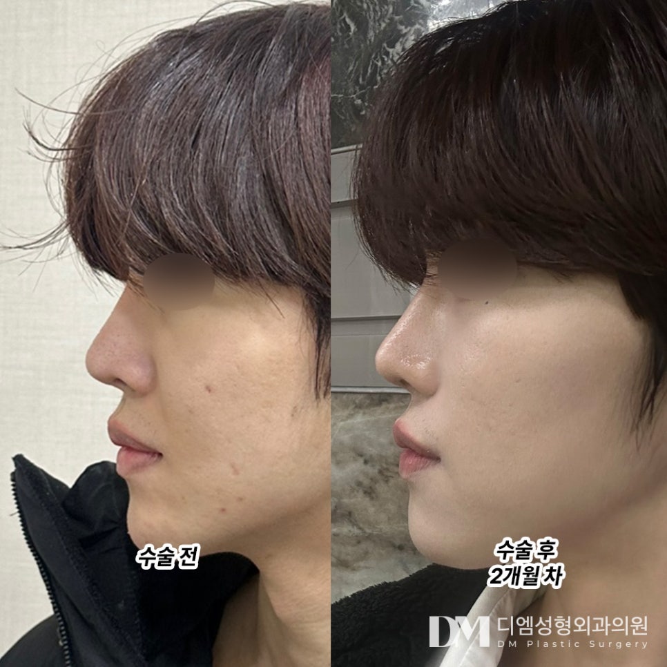 Improving Nasolabial Folds That Make You Look Older with a Partial Facelift image 7