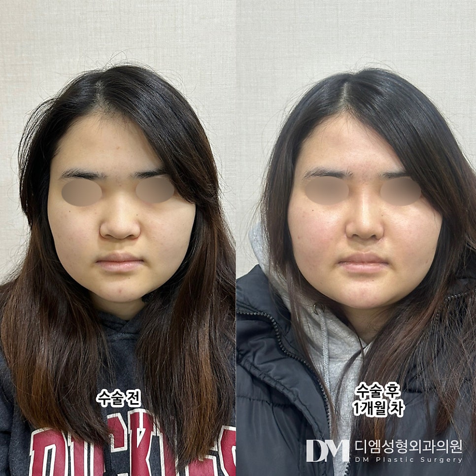 Bulbous Nose Surgery: No More Stress Over a Broad, Flat Nose! image 10