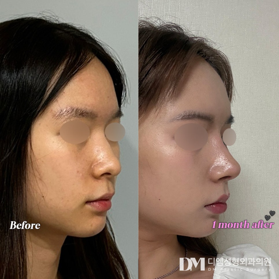 Creating a Sophisticated Nose Shape with Tip Rhinoplasty image 8