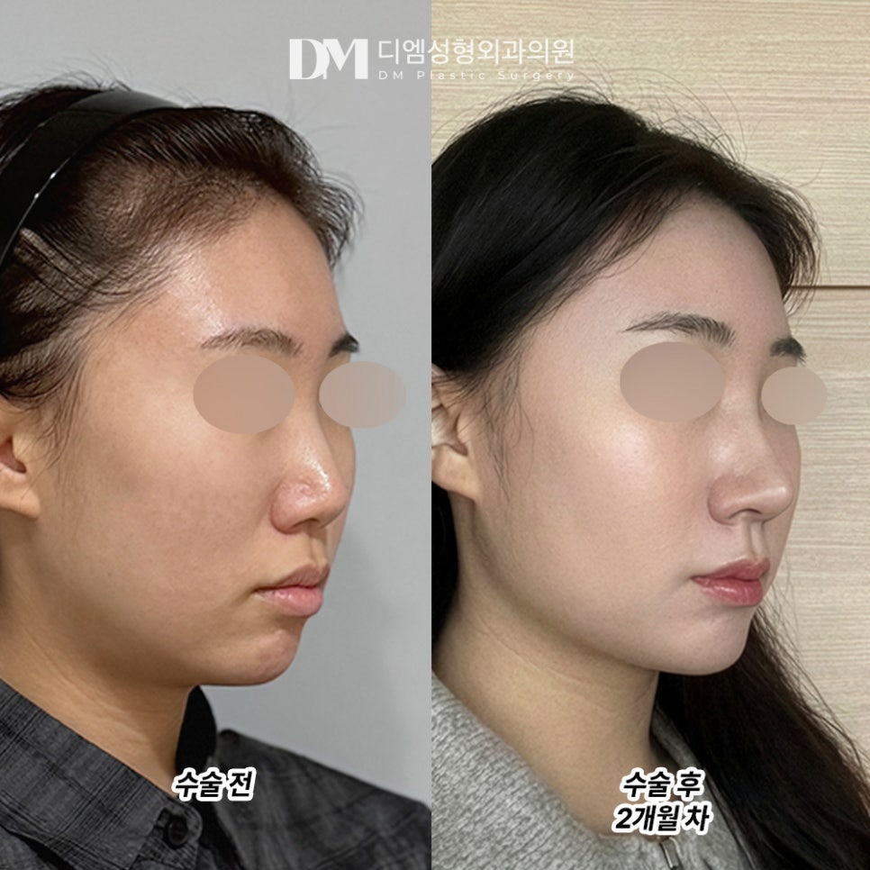 디엠 낮은코성형 전후사진, 입체적인 코 라인의 비결은? 관련 이미지 2