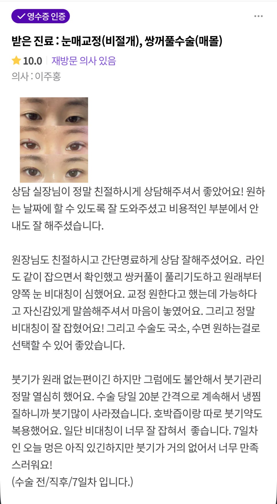 눈재수술 후기."비대칭이 너무 잘 잡혀서 좋습니다" 관련 이미지 1