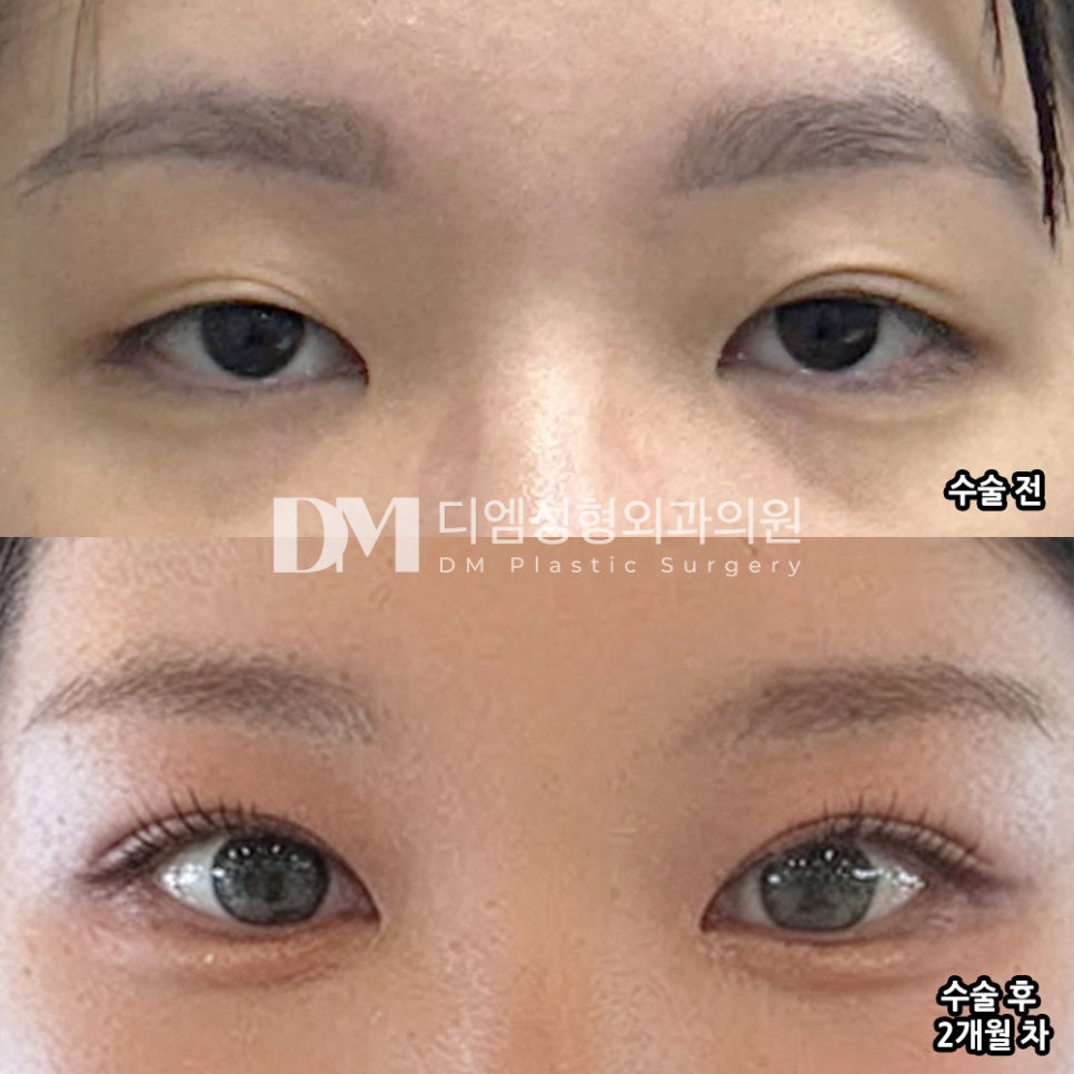 DM Revision Double Eyelid Surgery Review, “I’m satisfied because the line looks clean and well-defined!” image 2