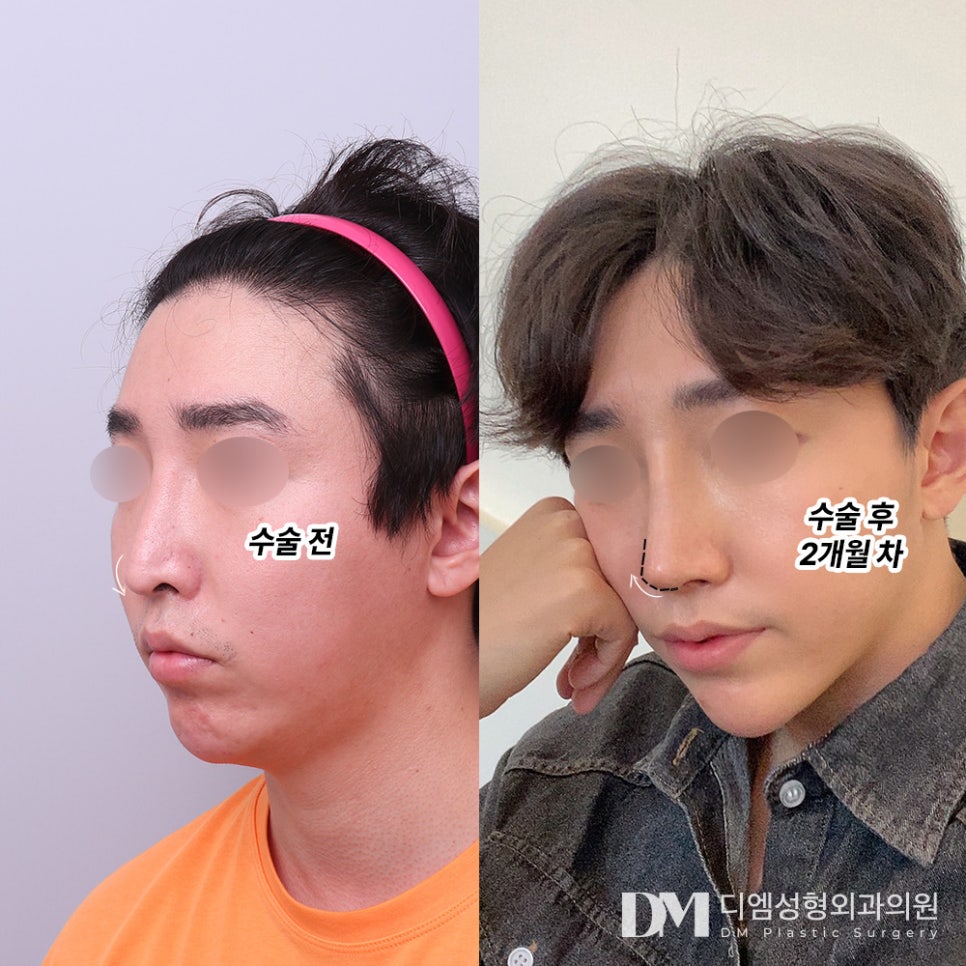 긴코,화살코 성형 나이들어보이던 코 교정하기 관련 이미지 6