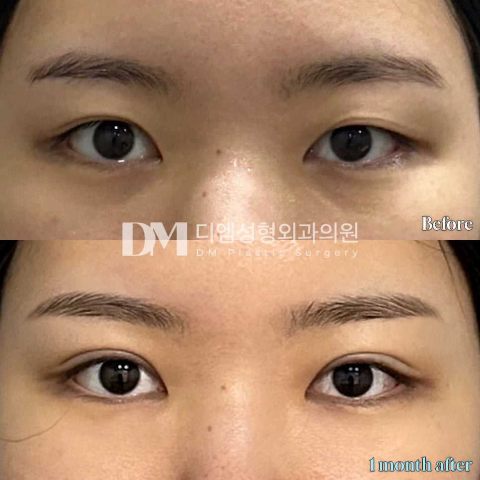 눈재수술 후기."주변에서도 인상이 또렷해졌다고 해줘서 자신감이 생겼어요!" 관련 이미지 2