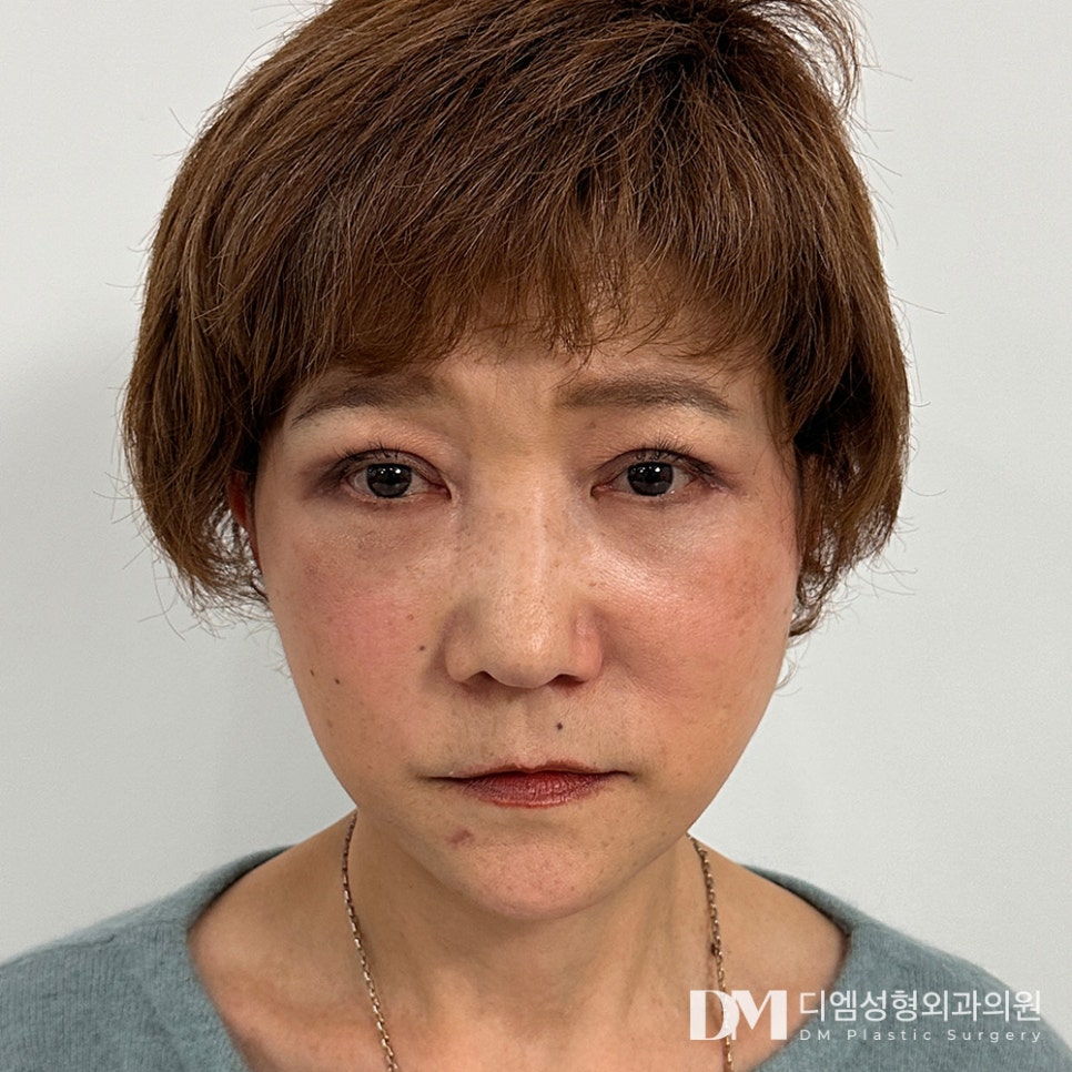 중년 동안성형 하안검,빠르게 젊음 되찾기 관련 이미지 12