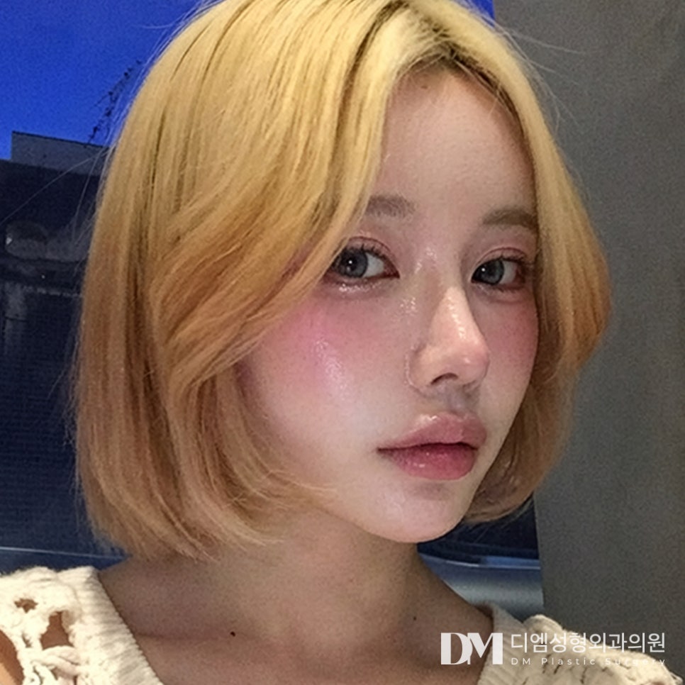 디엠 눈재수술 전후사진, 되찾은 또렷한 눈매! 관련 이미지 3