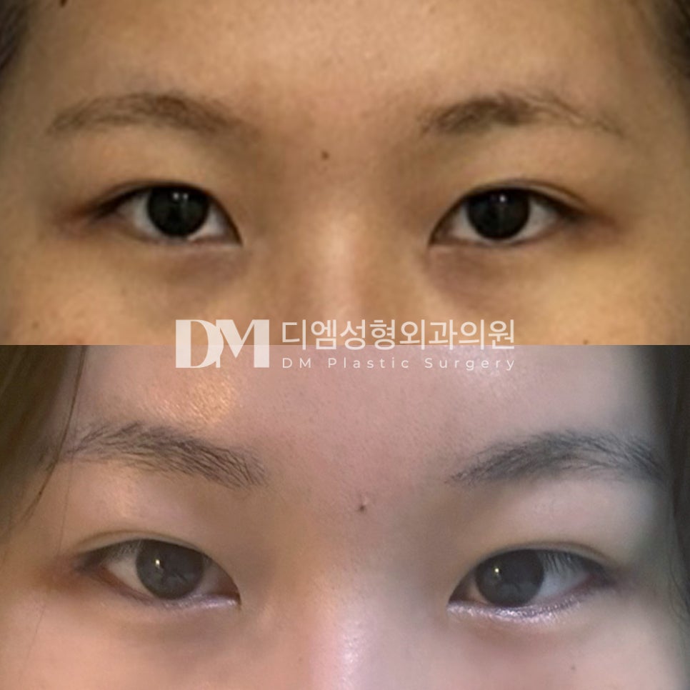 Canthoplasty Review: “I’m Very Satisfied! It Settled Naturally” image 2