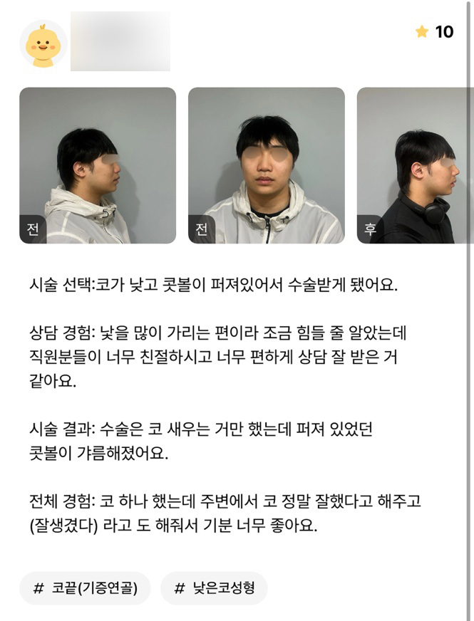 Nose Surgery Review. “I only had my nose done, but people around me said I did well and that I looked handsome, so I’m really happy!” image 1