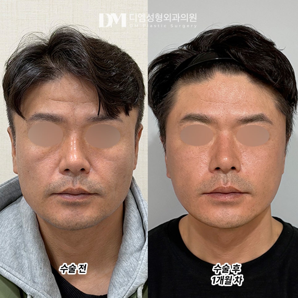 디엠 남자안면거상 전후사진, 무너진 인상을 바로잡는 관련 이미지 2