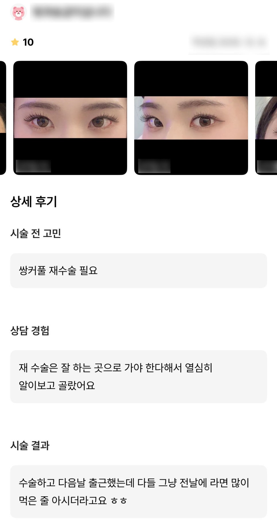 DM Revision Blepharoplasty Review, “Everyone thought I had eaten a lot of ramen the night before!” image 1