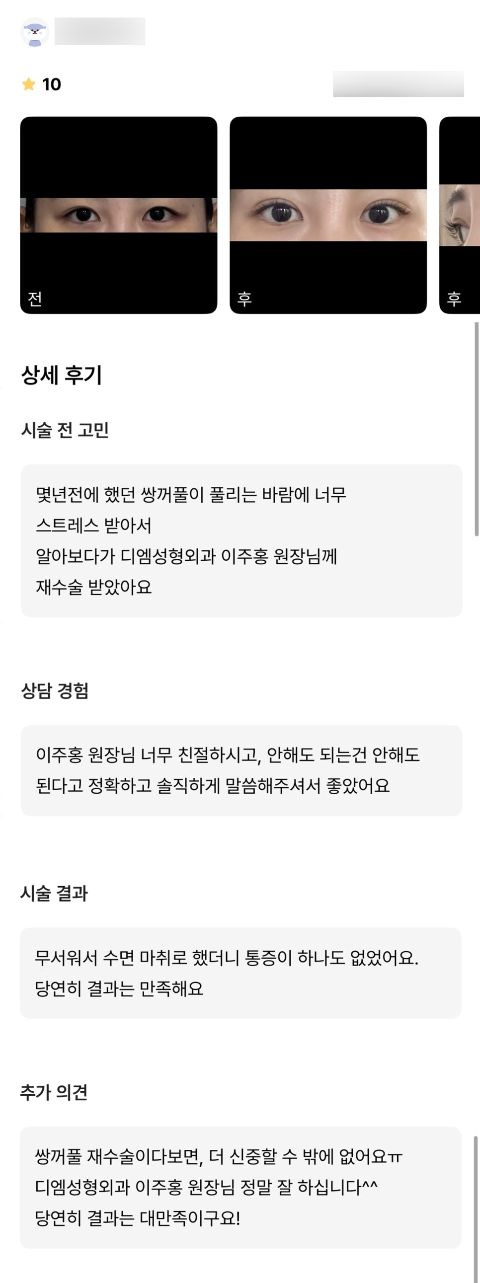 눈재수술 후기."신중하게 결정했는데 대만족입니다!" 관련 이미지 1