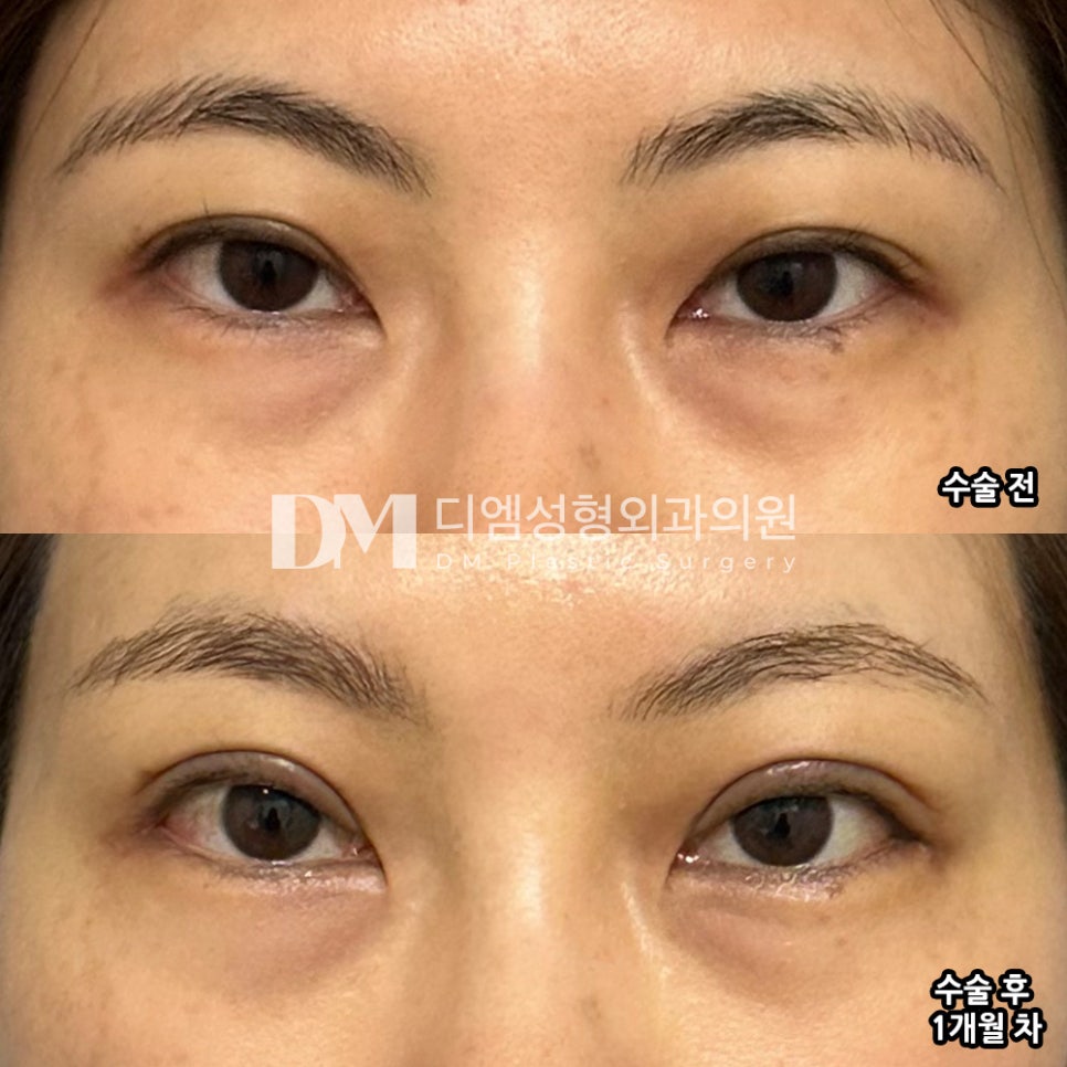 눈성형 후기."눈매가 한결 부드러워졌어요!" 관련 이미지 2