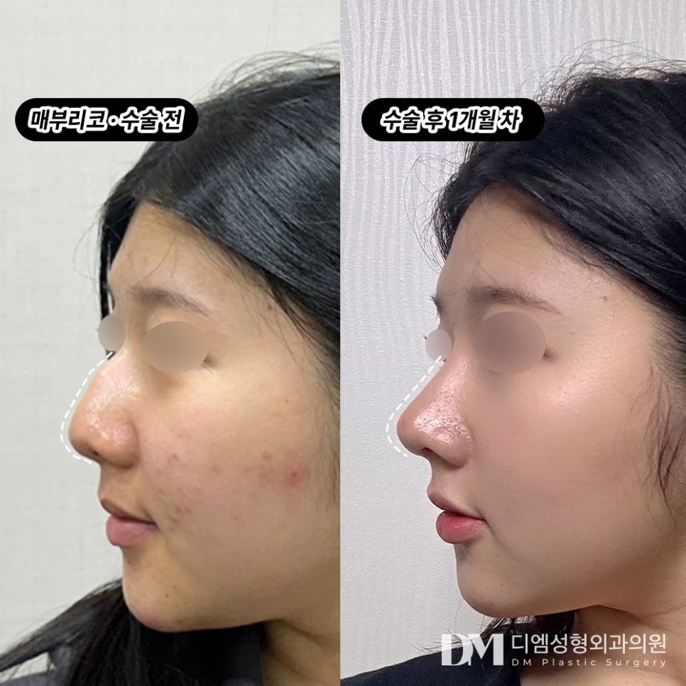 매부리코 , 미적 개선과 기능 개선을 동시에 ! 관련 이미지 6