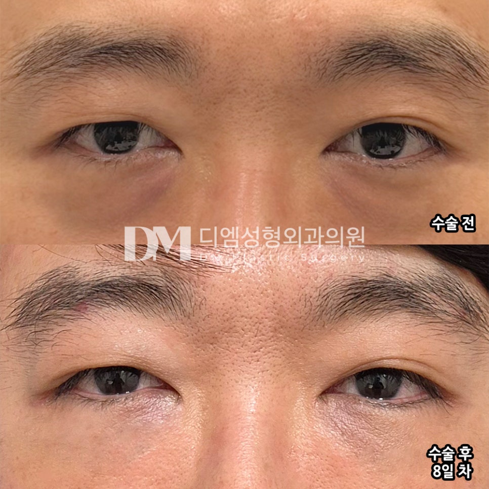 DM Under-Eye Fat Repositioning Surgery Review, “I’m glad I had my under-eye treatment before it was too late!” image 2