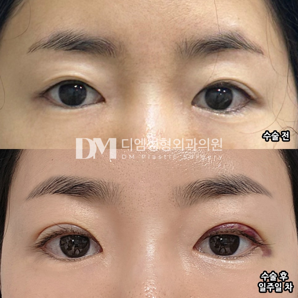 눈재수술 후기."붓기가 남아 있지만 라인이 예쁘게 잘 나올 것 같아요^^" 관련 이미지 2