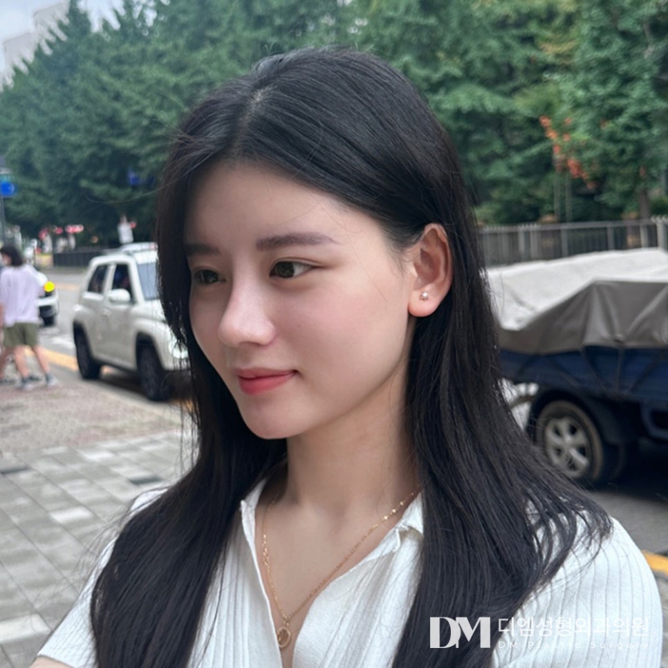 화살코성형 노안 이미지에서 벗어나기 관련 이미지 1
