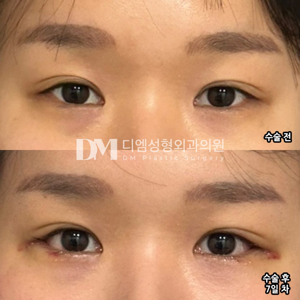빵트임 후기."눈 수술은 생각보다 자연스럽게 된 것 같아요!" 관련 이미지 2