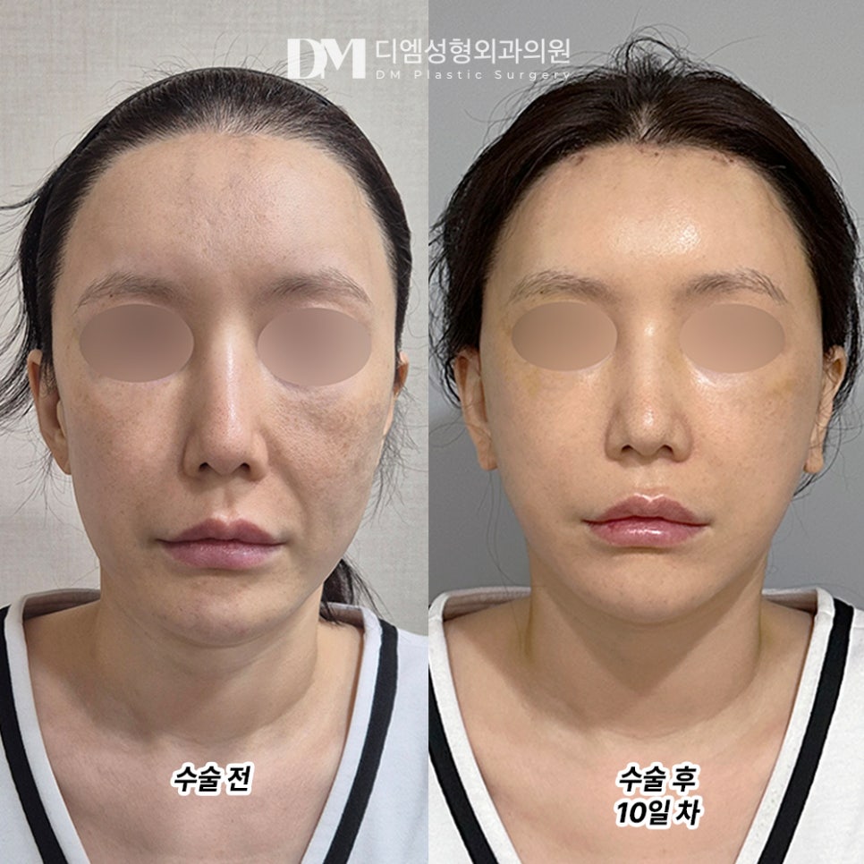 DM Facelift/Forehead Lift Surgery Review, “I’m Extremely Satisfied with the Results! I Feel Reborn!” image 2