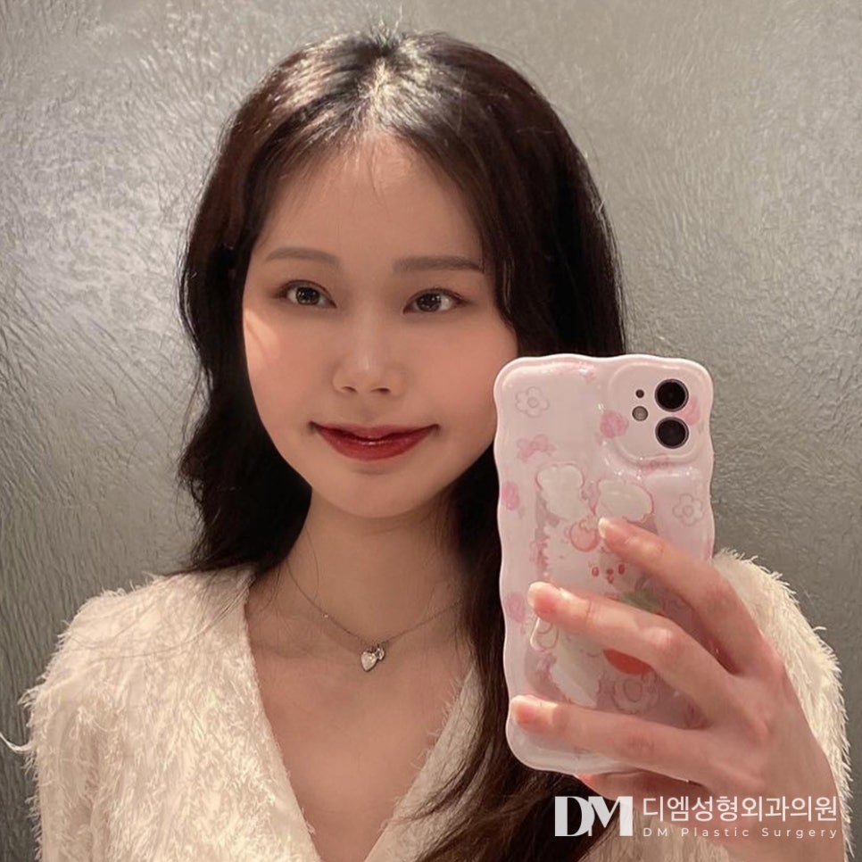 눈밑지방재배치로 다크서클과 노안 개선이 가능할까?? 관련 이미지 10