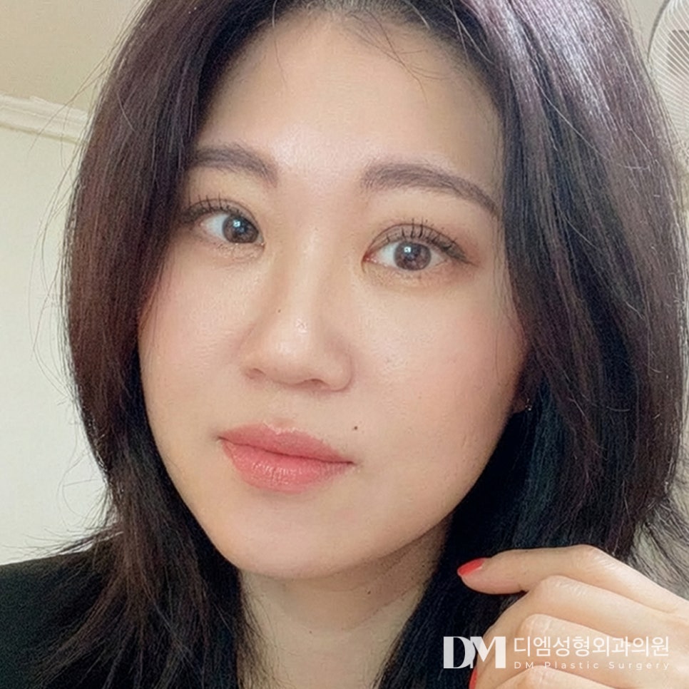 DM Facelift Before-and-After Photos: A Bright Smile Regained After Surgery, from the Forehead to the Jawline! image 1