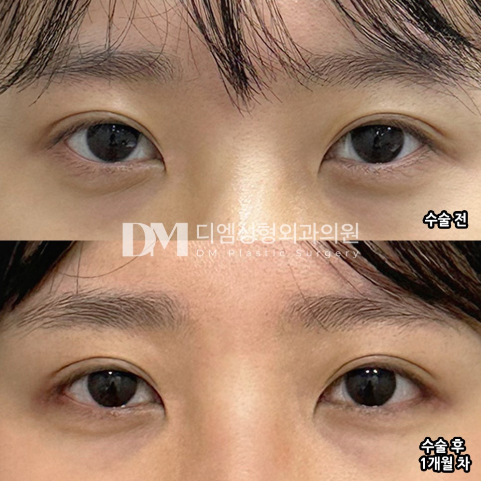 디엠 빵트임 수술후기, “만족스럽게 잘 트여진 것 같아 좋습니다!” 관련 이미지 2