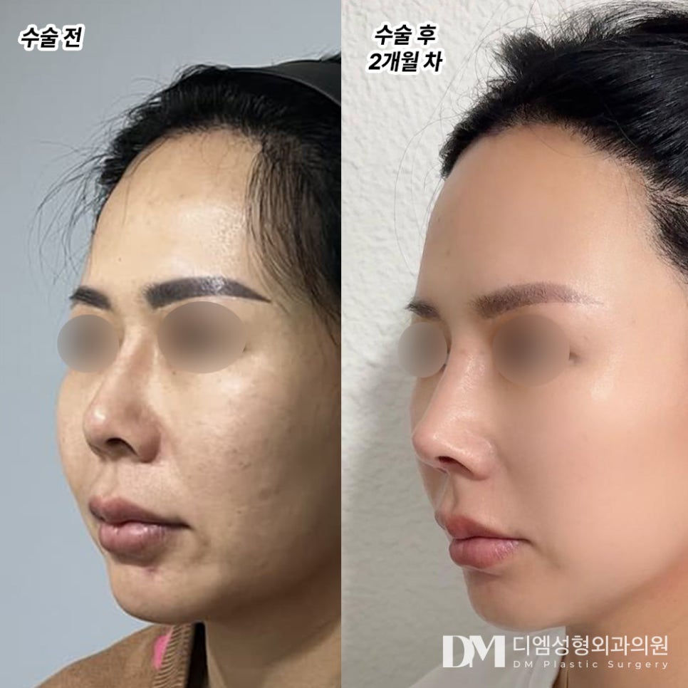 짧은코성형 세련된 옆라인 만들기 관련 이미지 8