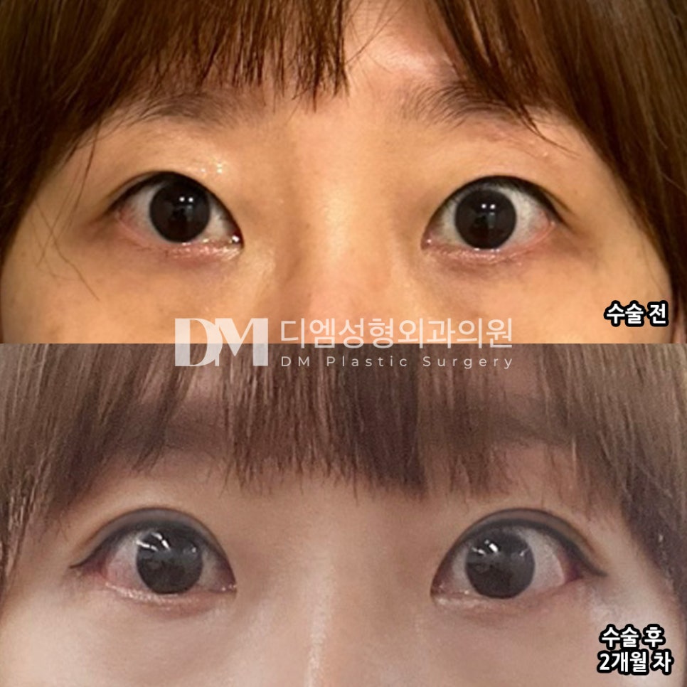 눈성형 후기."너무 자연스럽게 되서 원래 제 눈 같네요 " 관련 이미지 2