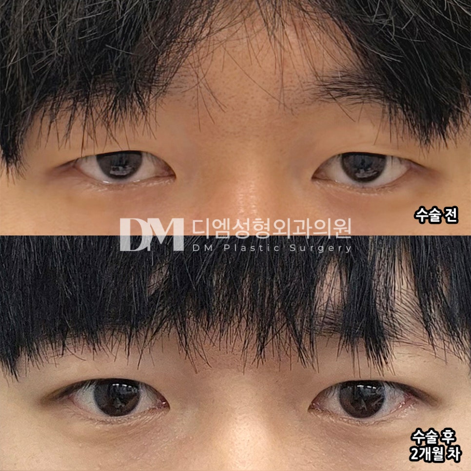디엠 남자눈성형/남자눈매교정 후기, “수술 후 눈에 힘주는 방법을 확실히 알게 됐습니다!” 관련 이미지 2