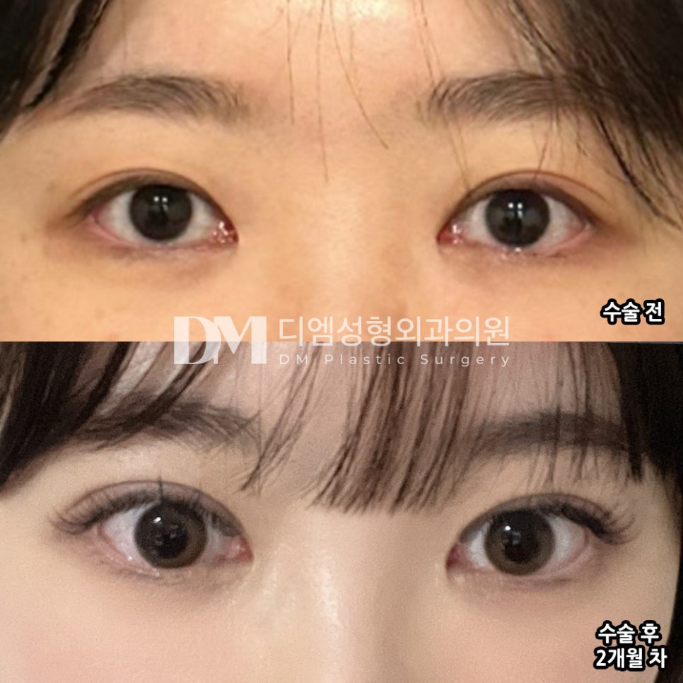 눈재수술 후기."얼마전에 수술한거라고 얘기하면 다들 놀라요!" 관련 이미지 2