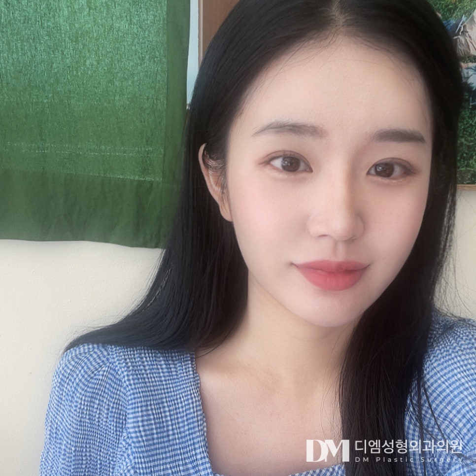 쌍꺼풀수술로 자연스럽게 인상 개선하기 관련 이미지 14
