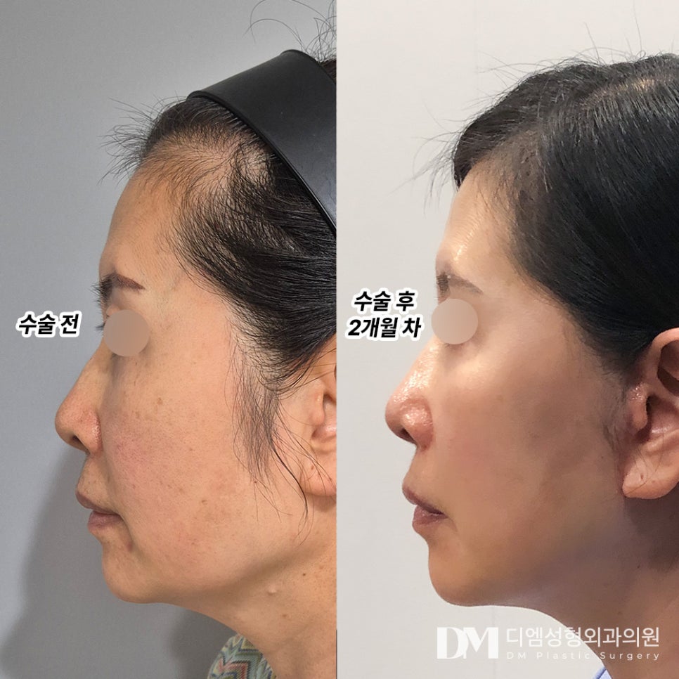 안면거상 후기."전체적으로 얼굴이 작아보인대요!" 관련 이미지 2