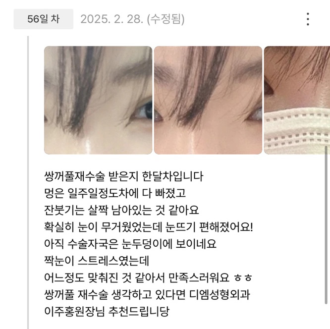 Eyelid Revision Surgery Review: “I’m satisfied that the symmetry has improved to some extent after surgery!” image 1