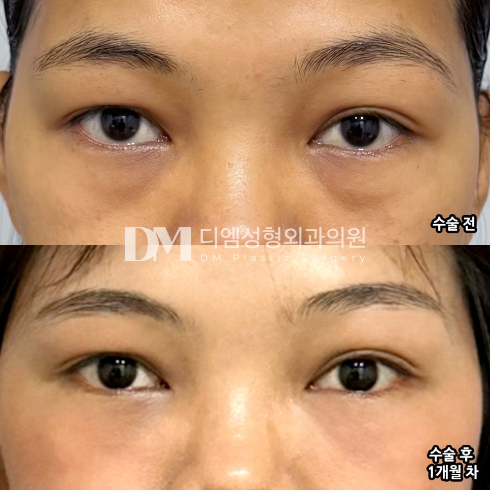 눈밑지방재배치 후기."눈 밑이 매끈해지고 인상이 한결 부드러워졌어요" 관련 이미지 2