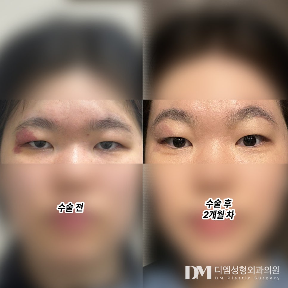 Blepharoplasty Review. "I liked that it was a procedure that allowed me to return to daily life right away!" image 2
