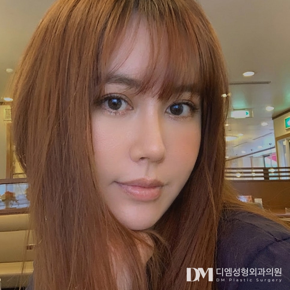 눈매교정 전 필수 체크! 나에게 맞는 수술법은? 관련 이미지 2