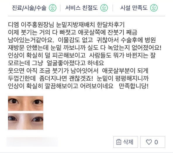 눈밑지방재배치 후기."눈밑이 평평해지니까 인상이 확실히 깔끔해보이고 어려보여서 만족합니다!" 관련 이미지 1