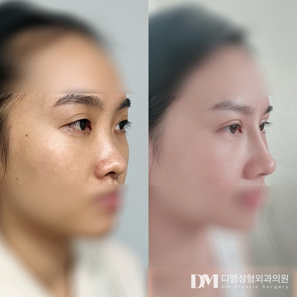 낮은코성형, 무조건 높은 코 보다는 내 이목구비에 맞게 ! 관련 이미지 9