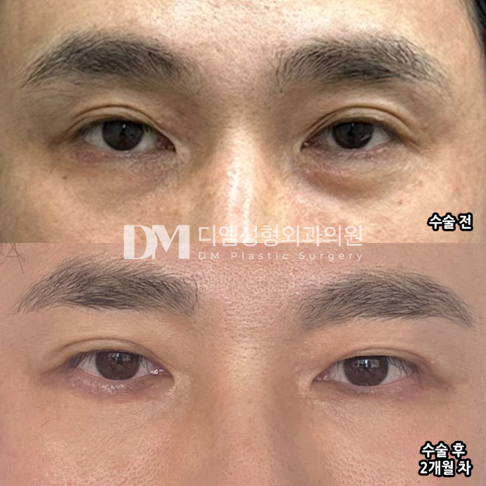 하안검 후기."지금은 하길 정말 잘했다는 생각이 듭니다" 관련 이미지 2